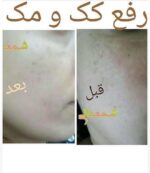 عکس قبل و بعد استفاده از روبینا گلد