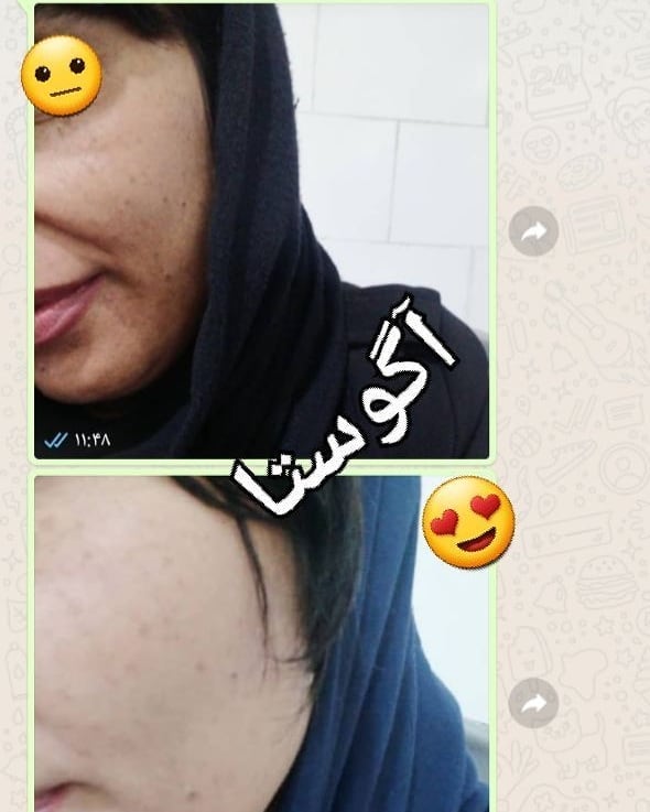 نمونه استفاده از کرم اگوستا