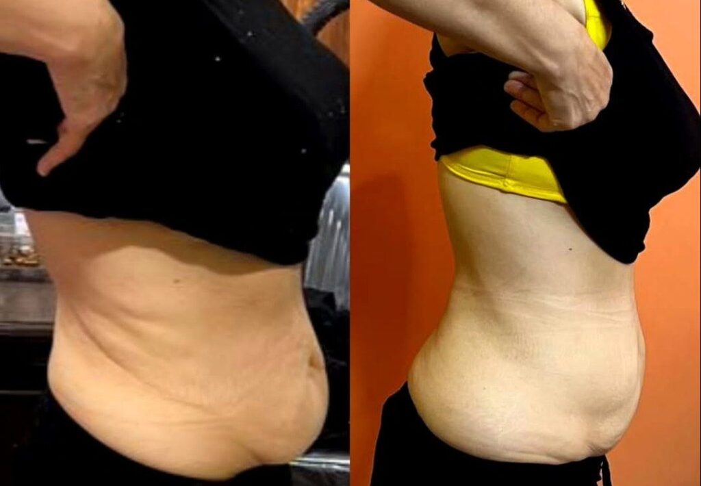 عکس قبل و بعد استفاده از ژل چربی سوز