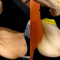 عکس قبل و بعد استفاده از ژل چربی سوز