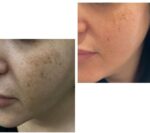 عکس-قبل-و-بعد-استفاده-از-کرم-گلدن-کویین