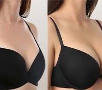 عکس قبل و بعد استفاده از ژل سینه