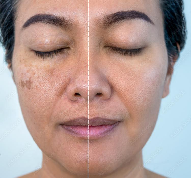 کدام لکه های پوستی خطرناکند